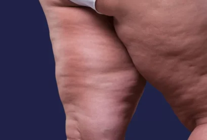 Lipodem-icin-hangi-doktora-gitmeliyim Lipodem-icin-hangi-doktora-gitmeliyim