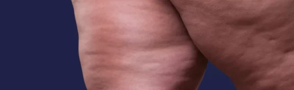 Lipodem-icin-hangi-doktora-gitmeliyim