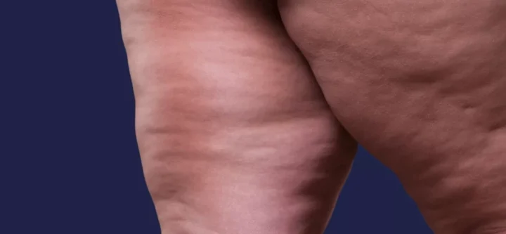 Lipodem-icin-hangi-doktora-gitmeliyim Lipodem-icin-hangi-doktora-gitmeliyim