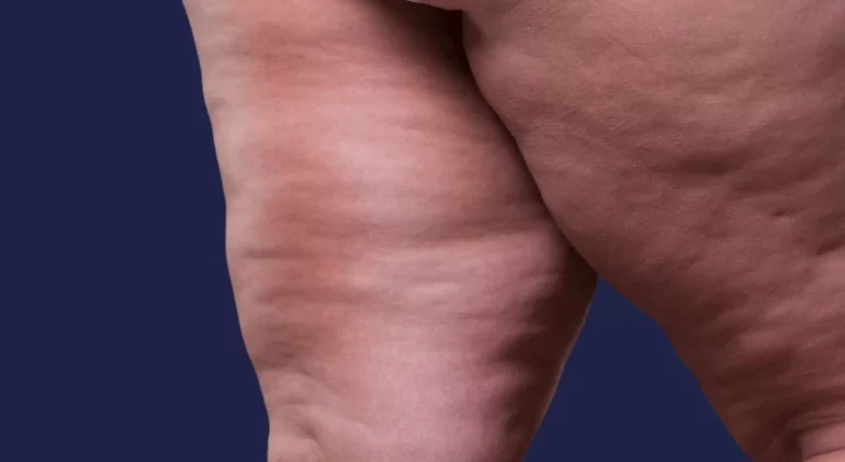 Lipodem-icin-hangi-doktora-gitmeliyim