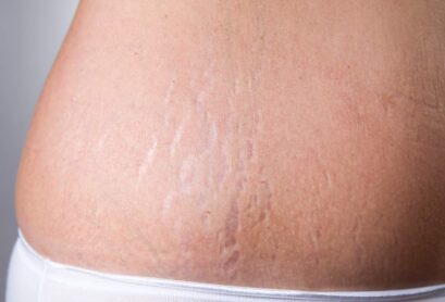stretch-mark-and-loose-skin-laser-1536x864 stretch-mark-and-loose-skin-laser-1536x864