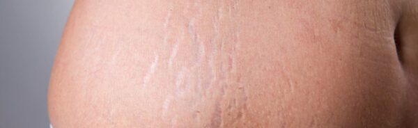 stretch-mark-and-loose-skin-laser-1536x864