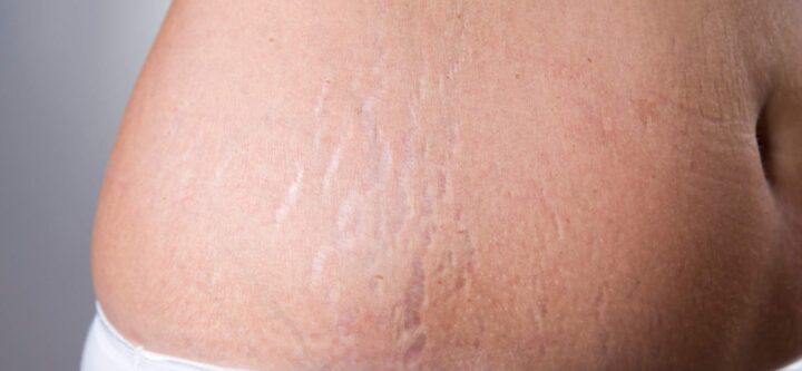 stretch-mark-and-loose-skin-laser-1536x864 stretch-mark-and-loose-skin-laser-1536x864