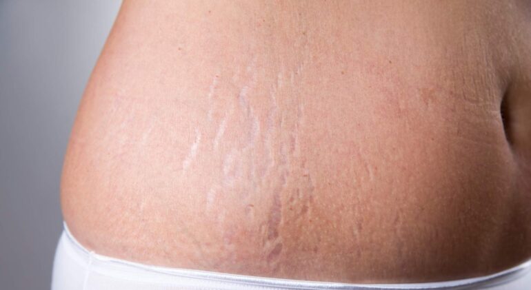 stretch-mark-and-loose-skin-laser-1536x864